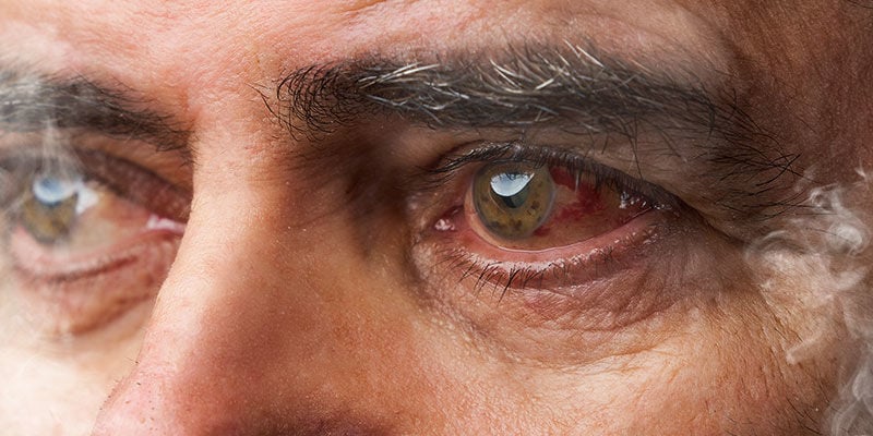 Perché la cannabis provoca gli occhi rossi?